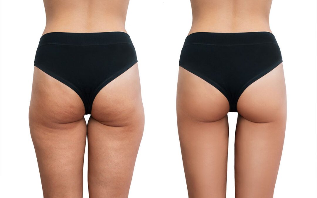 Lipedema vs. grasa localizada: claves para diferenciarlas