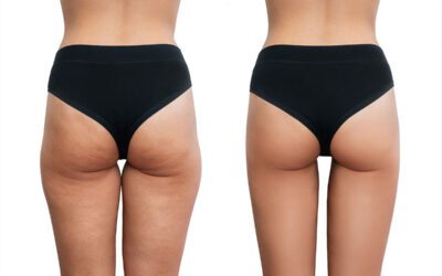 Lipedema vs. grasa localizada: claves para diferenciarlas