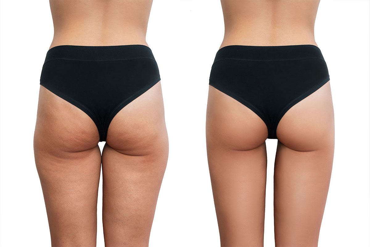 lipedema vs grasa localizada